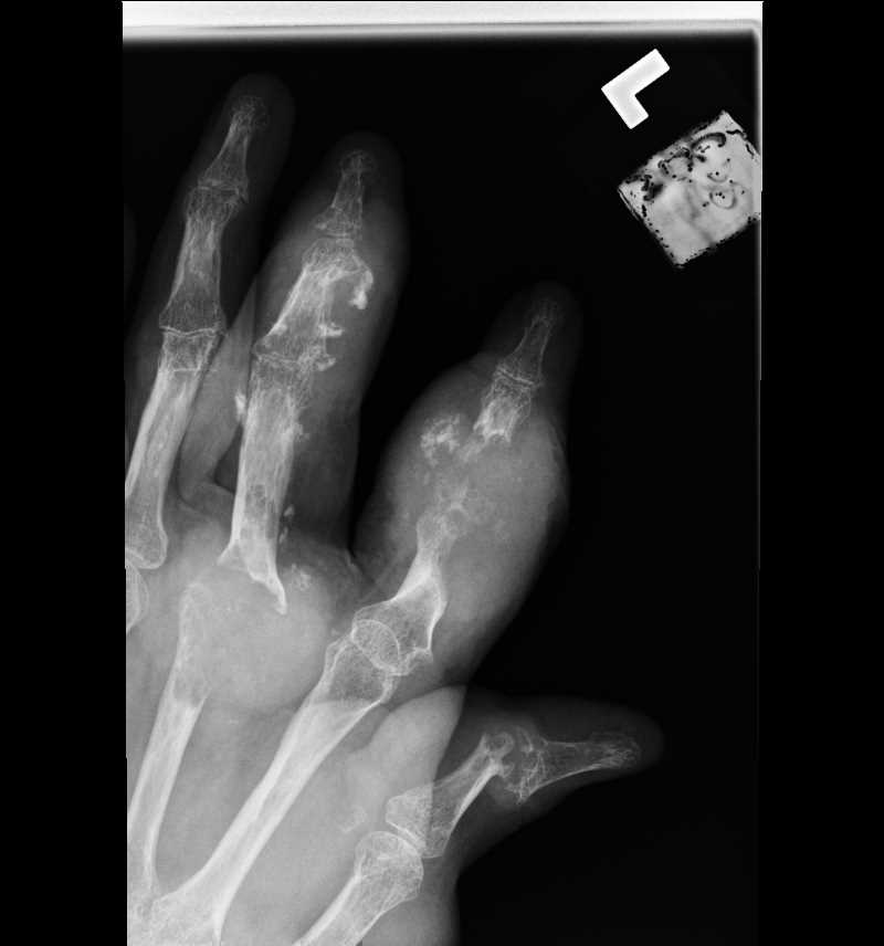 <p>Hand Radiograph of Chronic Gout