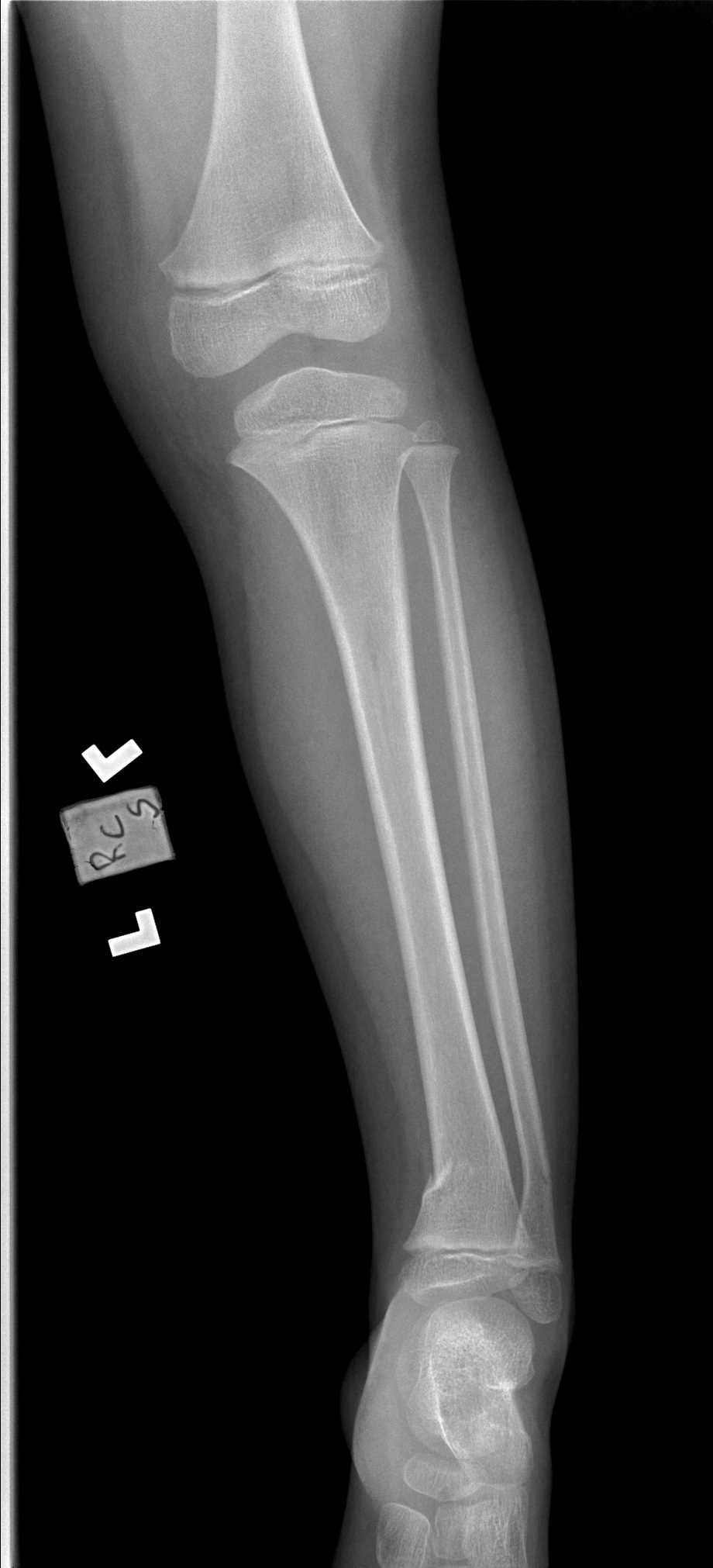 <p>Distal Tibia and Fibula Greenstick Fracture