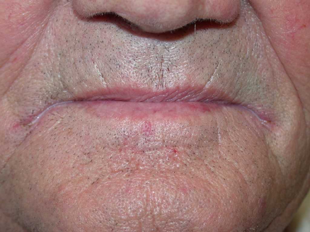 <p>Angular Cheilitis.</p>