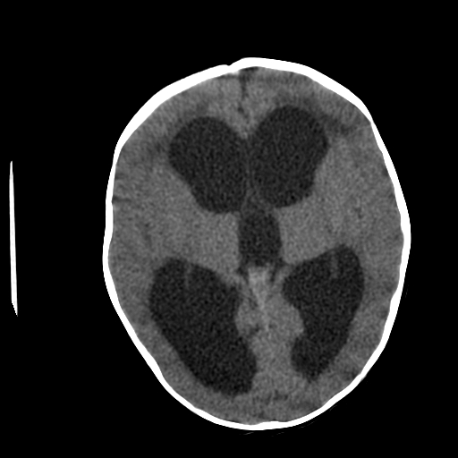 <p>Head CT,&nbsp;Hydrocephalus.</p>