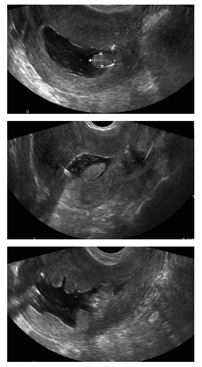 <p>Saline Infusion Sonogram. Image demonstrating an endometrial polyp visualized with saline infusion sonogram.</p>