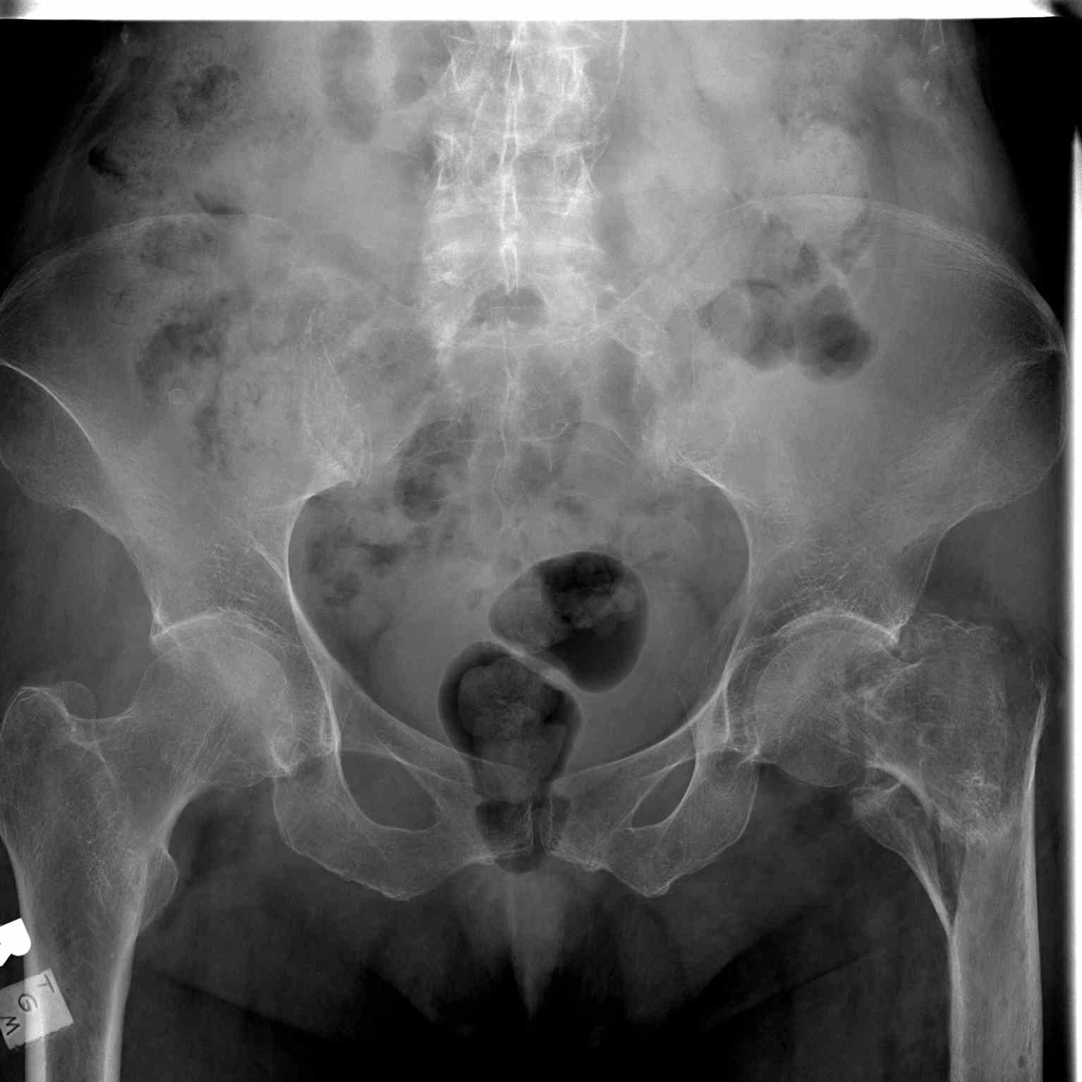 <p>Pelvic Radiograph, Left Hip Fracture.</p>