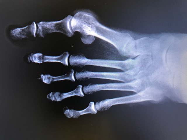 <p>Radiographic Hallux Valgus