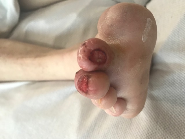 <p>Neuropathic Ulceration. Ulceration in a patient with diabetes. Note the prior hallux amputation</p>