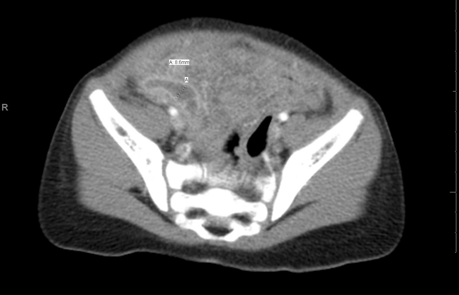<p>Abdomen CT, Acute Appendicitis.</p>