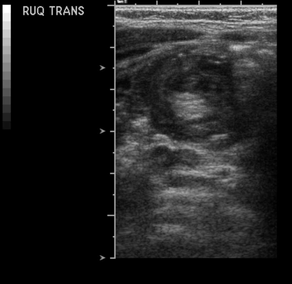 <p>Abdomen Ultrasonography, Intussuception Appendicolith