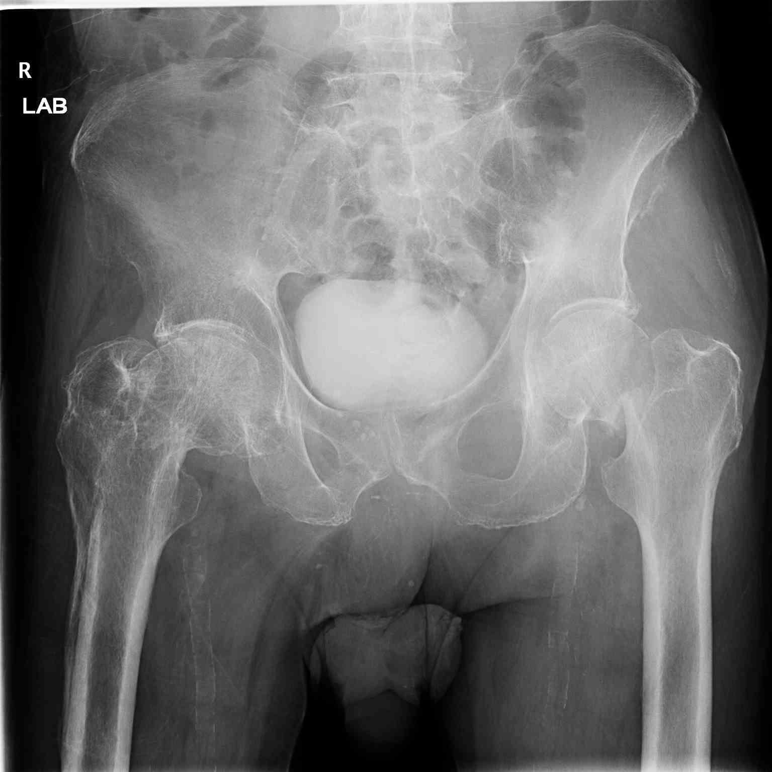 <p>Pelvic Radiograph, Right Hip Fracture.</p>