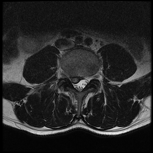 <p>Lumbar Spine Disk Herniation, Magnetic Resonance Image