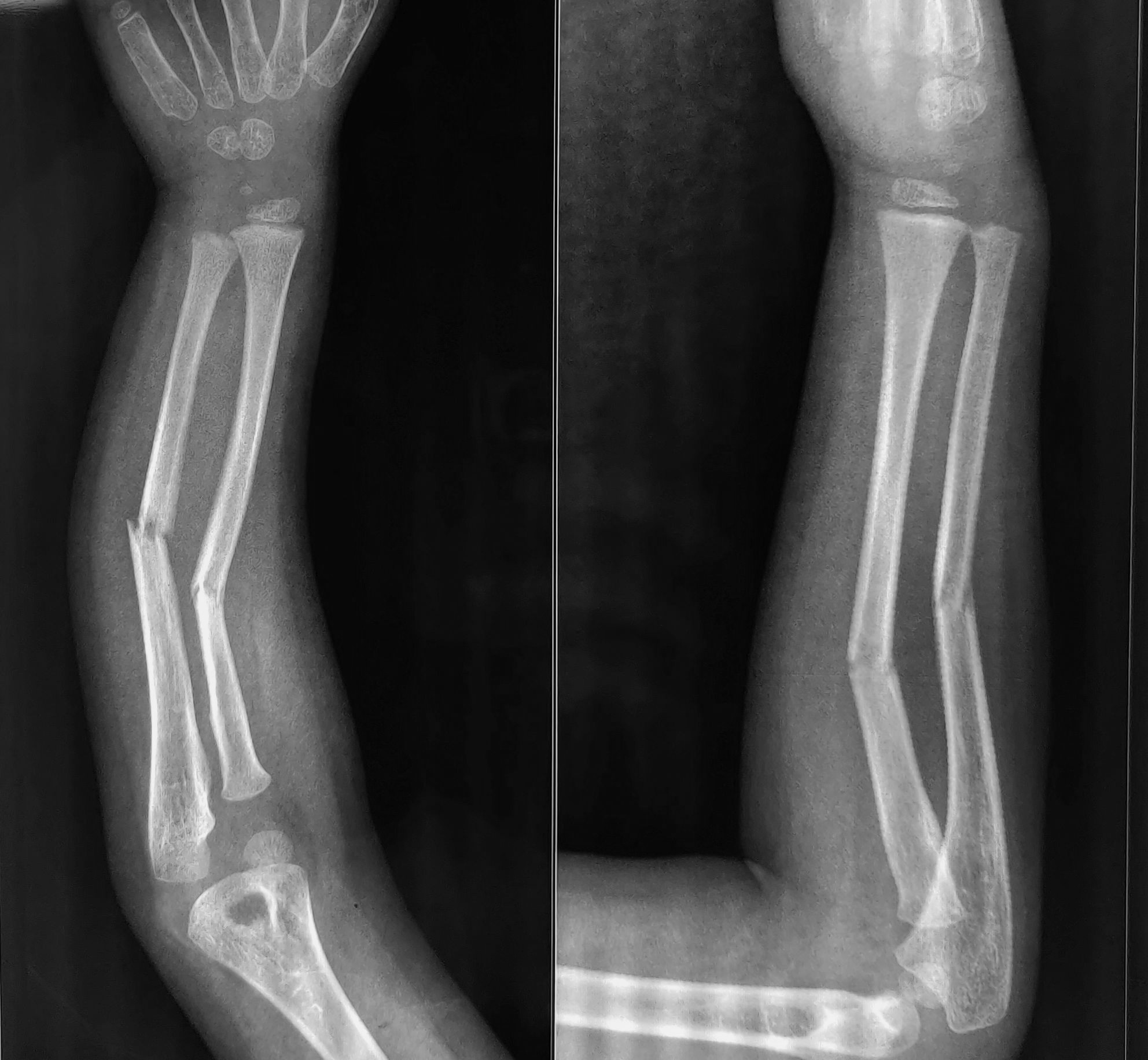 <p>X-ray of right forearm anteroposterior and lateral view in a five-year-old child showing middle-third both bone fracture