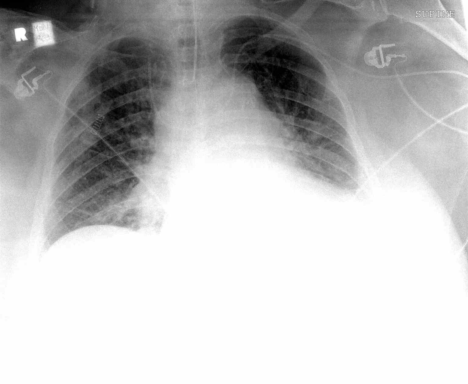 <p>Malpositioned Central Line,&nbsp;Chest Radiograph.</p>