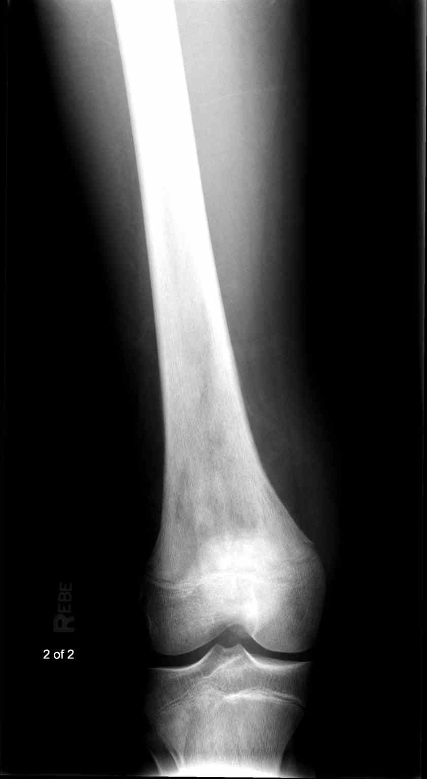 <p>Osteogenic Sarcoma