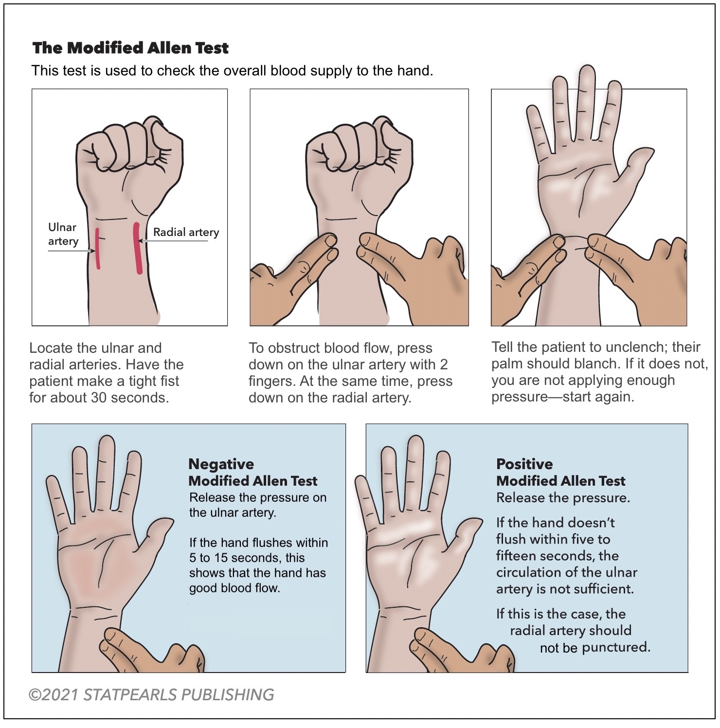 <p>Modified Allen Test. This test is used to check the overall blood supply to the hand.</p>