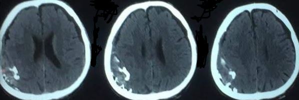 <p>Calcified Parietooccipital Epidural Hematoma