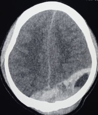 <p>Epidural Hematoma of Sinus Origin