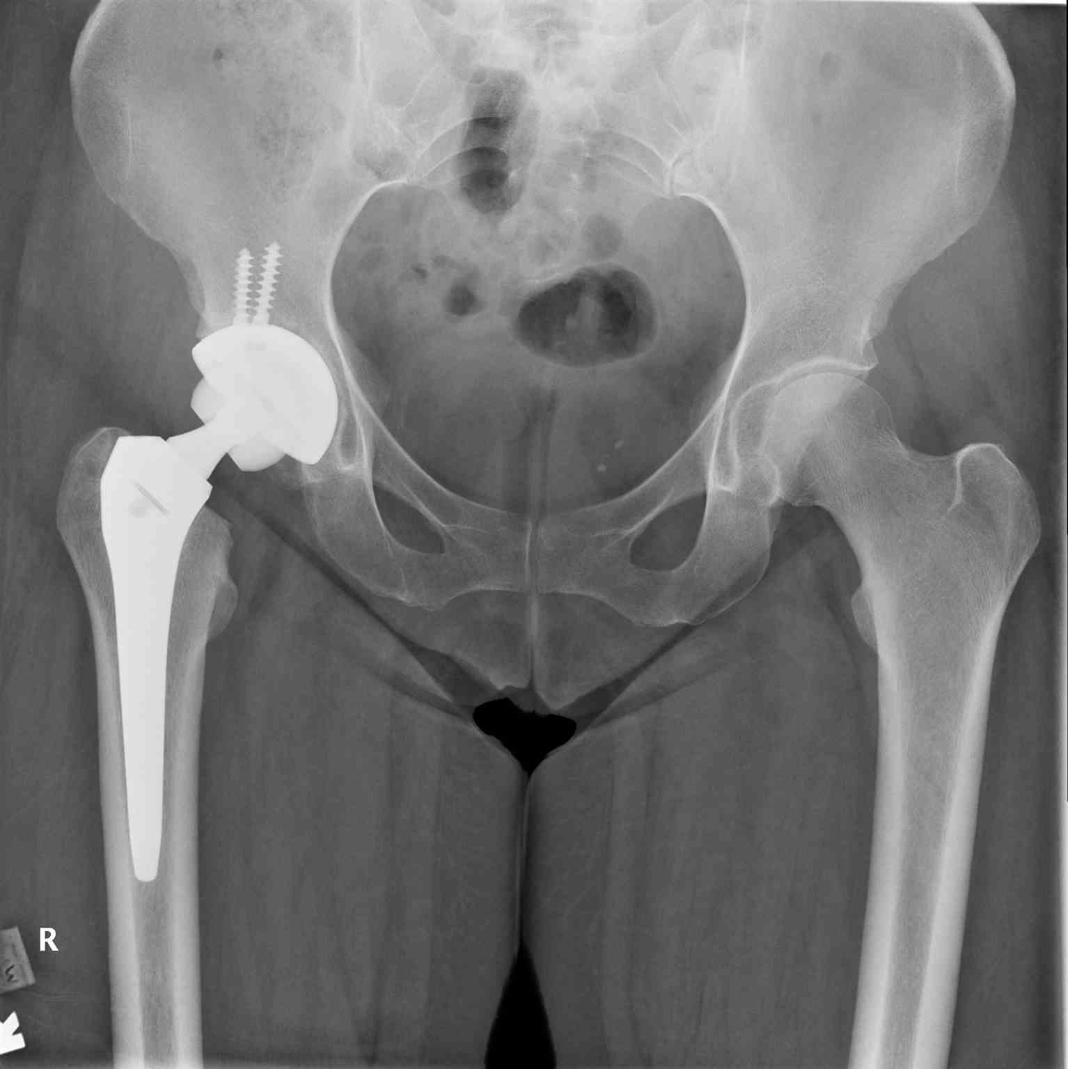 <p>Right Hip Arthroplasty,&nbsp;Pelvic Radiograph.</p>