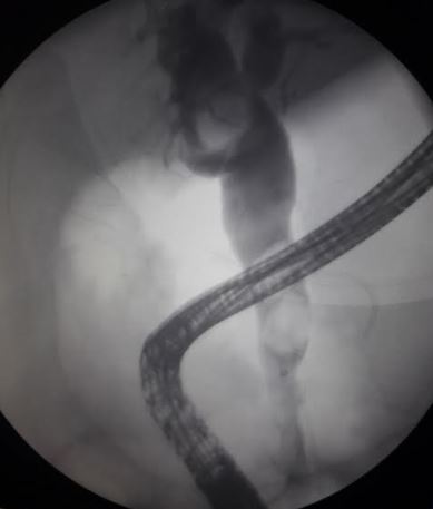 <p>Common Bile Duct Stones, Endoscopic Retrograde Cholangiopancreatography (ERCP)