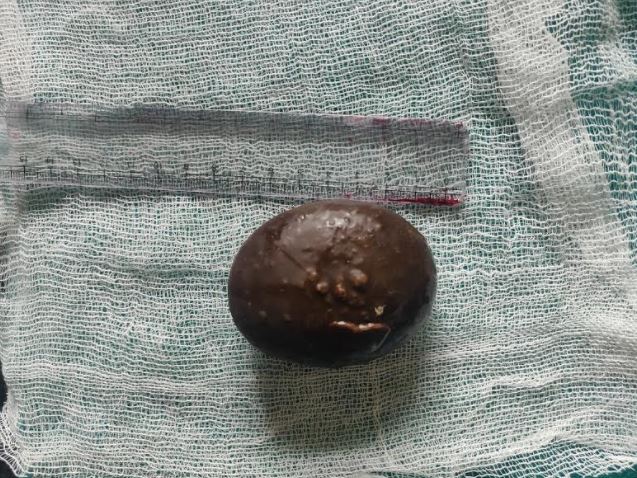 <p>A Bladder Calculus