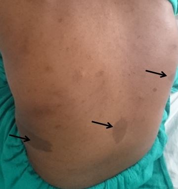<p>Multiple Caf&eacute; au Lait Macules with Truncal Distribution