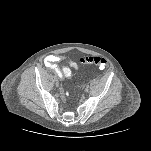 <p>Submucosal Edema, Abdomen CT.</p>