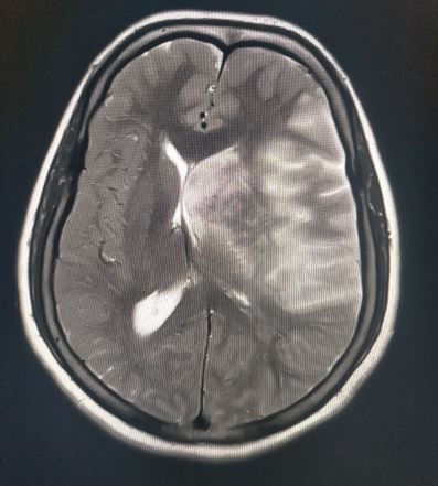 <p>Subfalcine Herniation