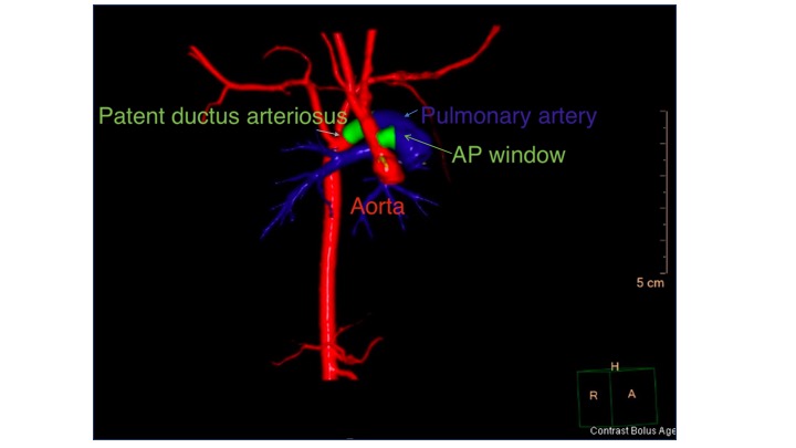 <p>Three-Dimensional Computed Tomography Reconstruction of Aortopulmonary Window