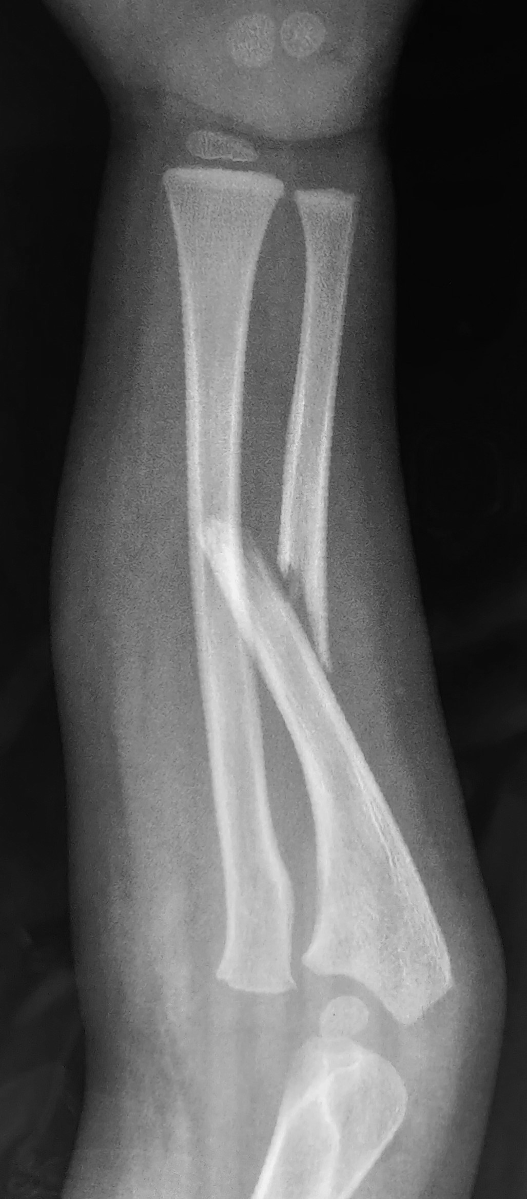 <p>An x-ray of right forearm showing Monteggia fracture-dislocation</p>