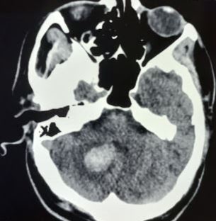 <p>Cerebellar Hematoma. Most hemorrhages appear as hyperdense lesions within the cerebellum.</p>