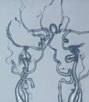 <p>Basilar Tip Aneurysm