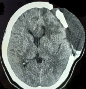 <p>Pseudomeningocele, Computed Tomography