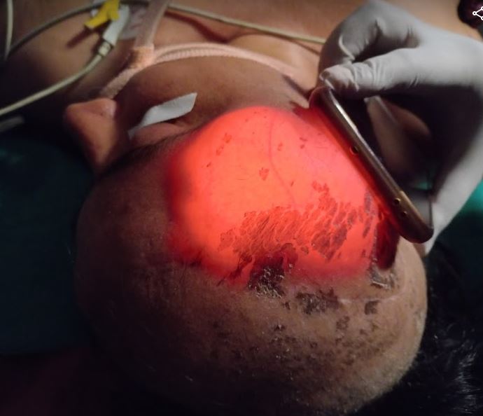<p>Pseudomeningocele. This image shows a patient with a large pseudomeningocele.</p>