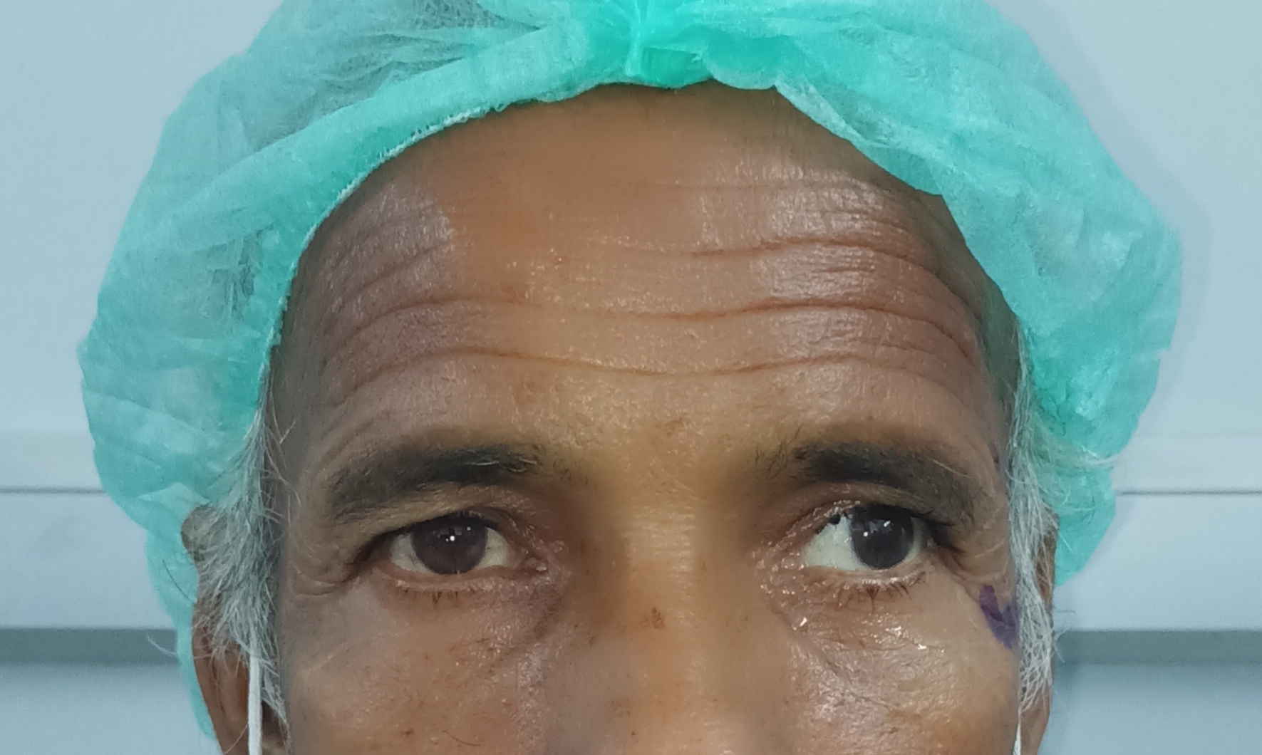 <p>Exotropia (20 degrees) and Hypertropia (10 degrees), Left Eye