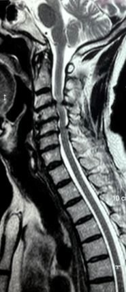 <p>Cervical Spondylosis, Magnetic Resonance Image