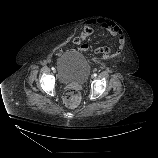 <p>Ventral Hernia,&nbsp;Abdomen CT.</p>