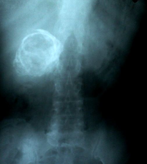 <p>Porcelain Gallbladder