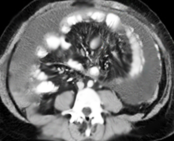 <p>Abdomen/Pelvis Encapsulating Peritoneal Sclerosis, Computed Tomography