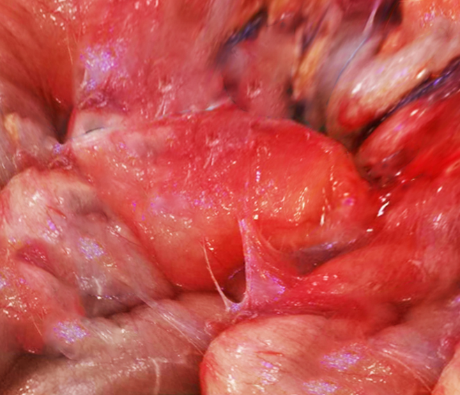 <p>Encapsulating Peritoneal Sclerosis