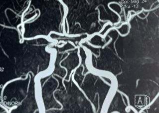 <p>Left Anterior Cerebral Artery Stenosis. Stenosis of the first segment of the left anterior cerebral artery.</p>