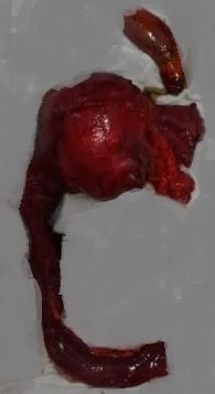 <p>Resected Choledochal Cyst Specimen