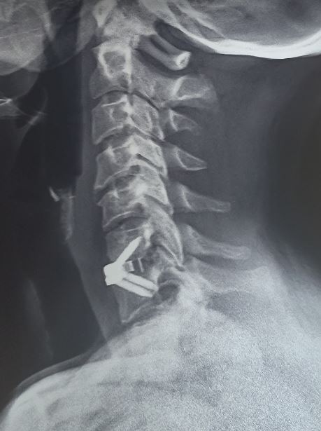 <p>Zero Profile Implant, Cervical Disc Prolapse Radiograph