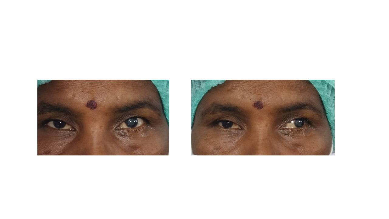 <p>Orthotropia and Exotropia