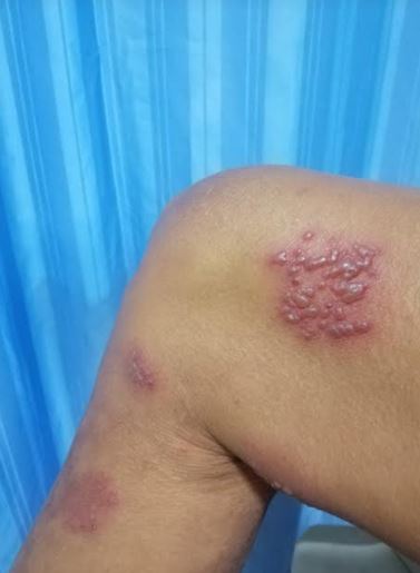 <p>Herpes Zoster Vesicles