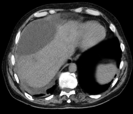 <p>Hepatic Biloma on Computed Tomography