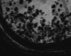 <p>Disseminated Cerebral Amyloid Angiopathies