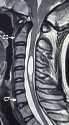 <p>Arnold-Chiari Malformation with Syringomyelia on Magnetic Resonance Imaging