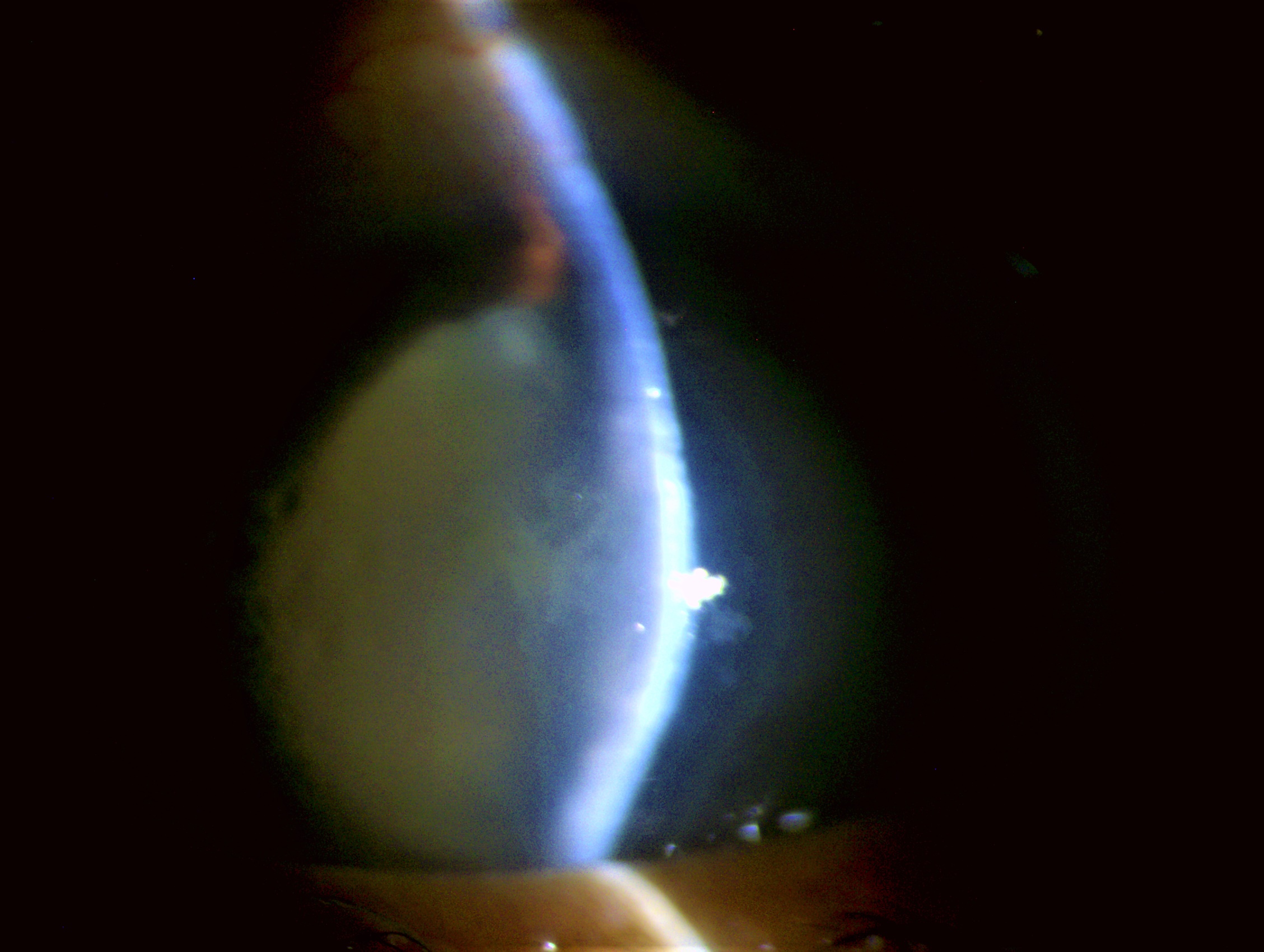 <p>Phacomorphic Glaucoma