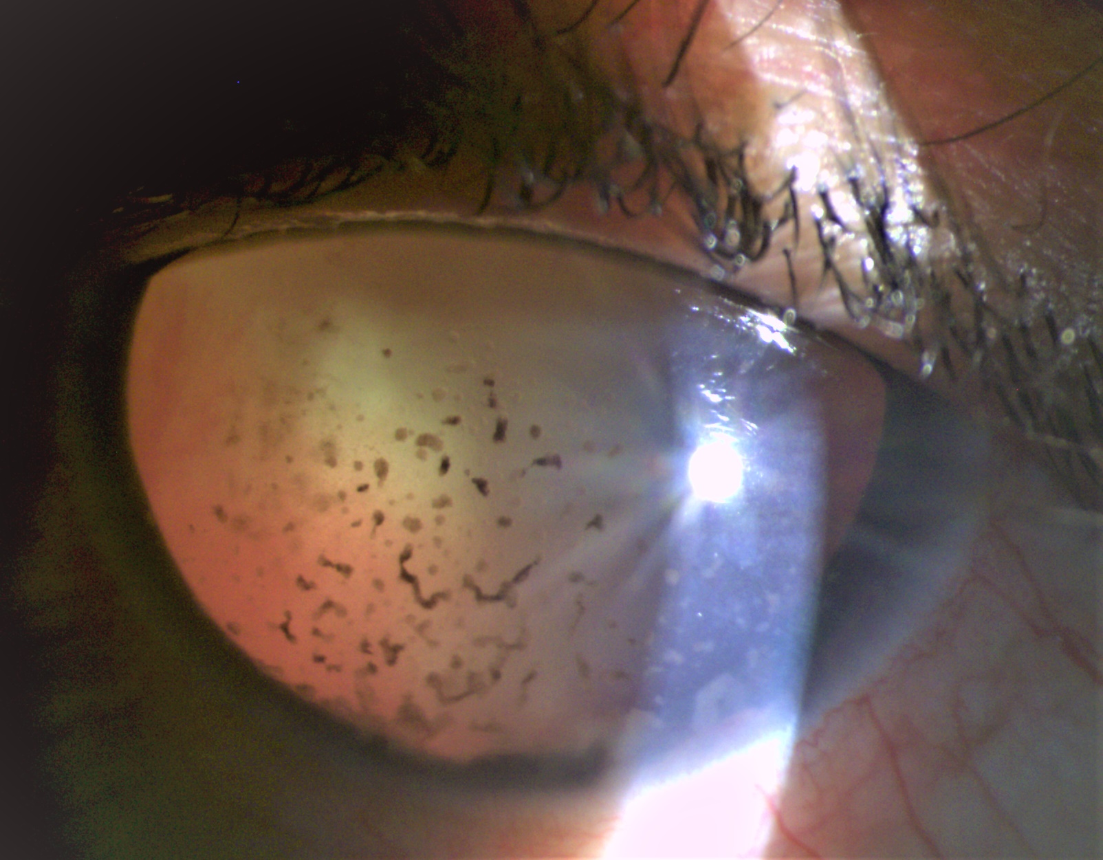 <p>Phacoanaphylactic Glaucoma