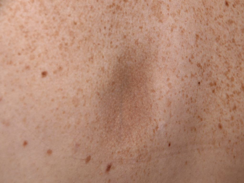 <p>Atrophoderma Pierini Pasini.</p>