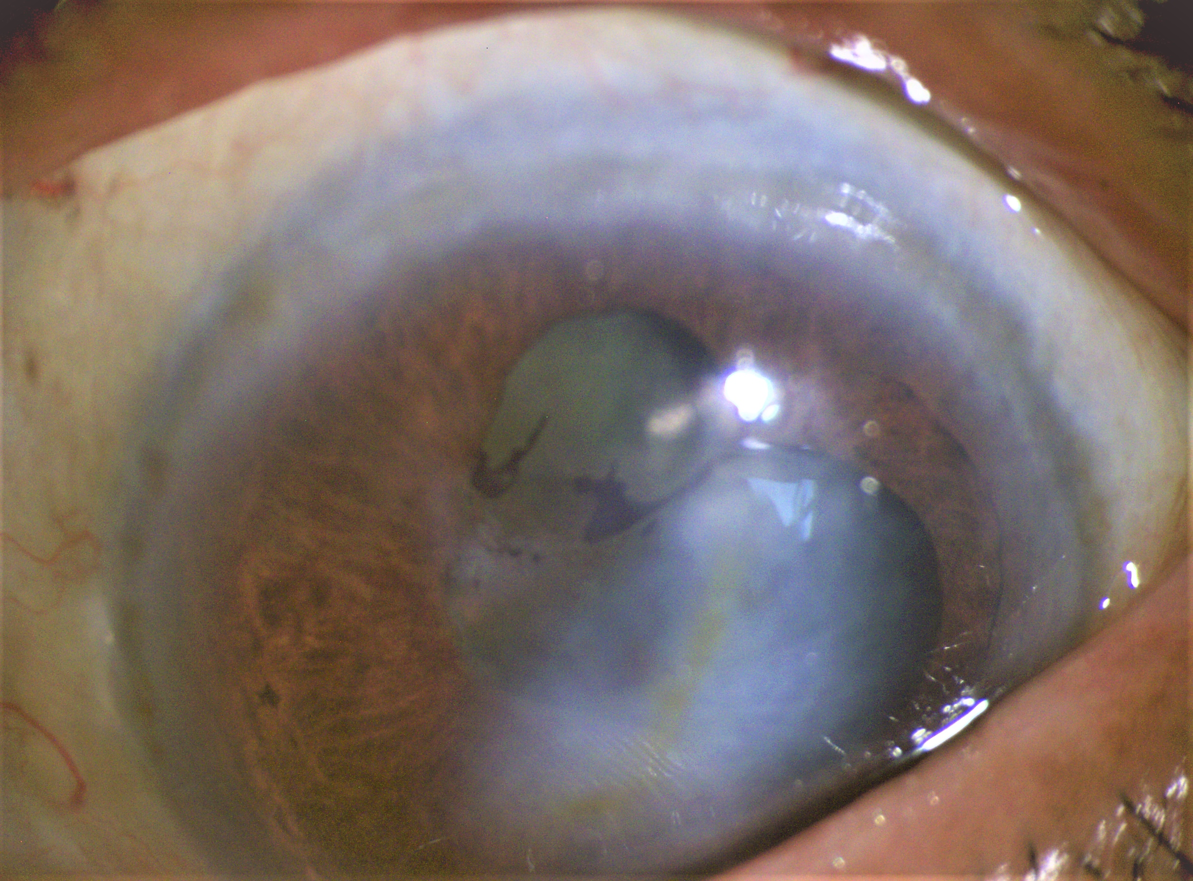 <p>Phacolytic Glaucoma