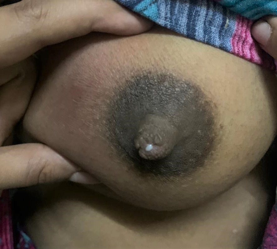 <p>Breast Abscess. Right breast abscess in a lactating mother.</p>