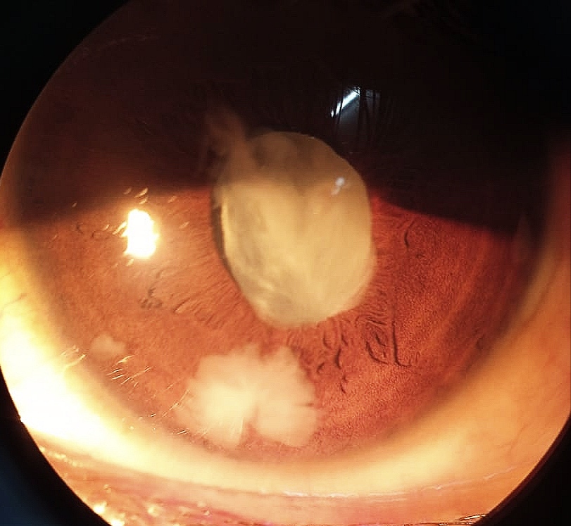 <p>Lens Particle Glaucoma
